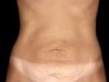 abdominoplastie